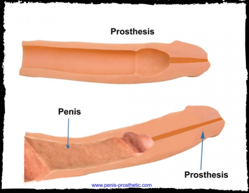 realistic penis prosthetic